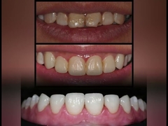 Custom OEM Dental Porcelain Veneer Firm Wear Resistant For Dental Restoration