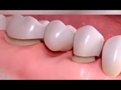 Wear-Resistant High-Strength PFM Denture Crown Aesthetic