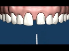 CO CR MK1 정밀 부가 장치 틀니 부식 저항성