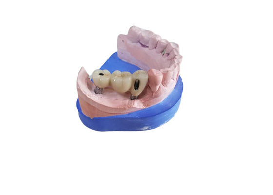 CAD CAM Zirconia Dental Crown With Titanium Base Zirconia Abutment