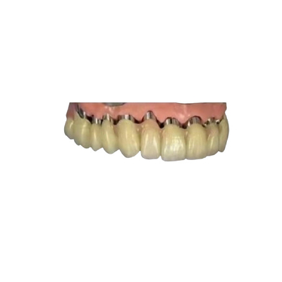 CAD 캠 PFM 임플란트 치관 다리 육안으로 보이지 않는 크라운 치아 인쇄된 모델들 3D명