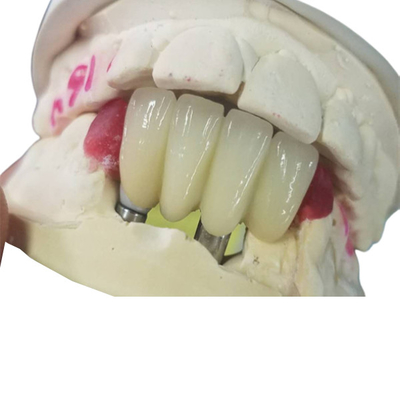 치아 임플란트 치관을 분쇄하는 강한 Ti 기반은 지원받는 브릿지를 맞물립니다