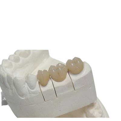 일시적 CAD / 캠 PFM 치아관 3D 프린팅 디자인 틀니 특화