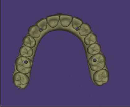 Design AOX Professional Full Arch Implant Bridge Design Service