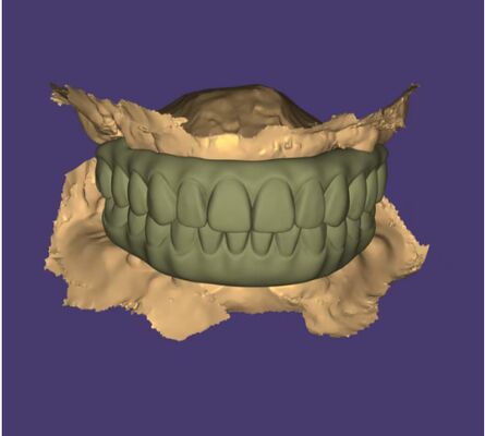 Design AOX Professional Full Arch Implant Bridge Design Service