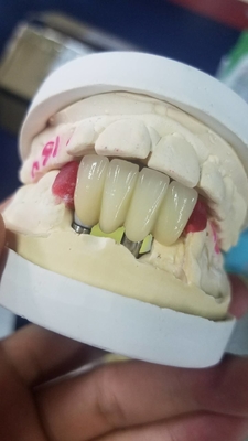 쉬운 평활 표면 생체조직이나 기관과 잘 교합할 수 있는 산화 지르코늄 치아 보철물은 유지합니다