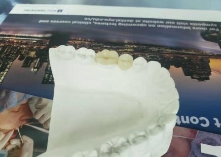 오래가는 탄력적 PFM 다리 크라운 치아 IPS Ｅ 맥스 언론 인레이 온레이