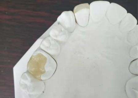 오래가는 탄력적 PFM 다리 크라운 치아 IPS Ｅ 맥스 언론 인레이 온레이