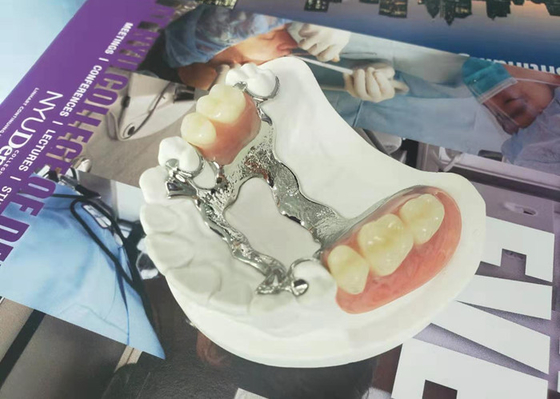 냇루랄은 치과의사 연구를 위한 3D 프린팅 고정된 제거가능한 의치를 그늘지게 합니다