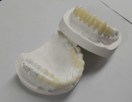 높은 내구성 CAD CAM 3D 인쇄 임시 크라운 튼튼한 수지
