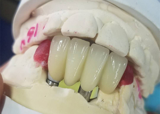 치아 임플란트 치관을 분쇄하는 강한 Ti 기반은 지원받는 브릿지를 맞물립니다