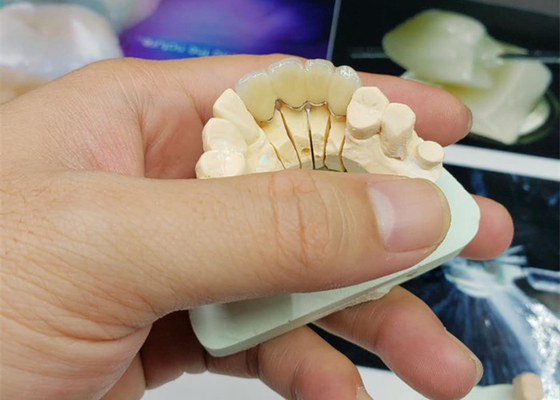 안전성 내부식 OEM 자기는 모든 요업 자연스런 외관을 관을 씌웁니다