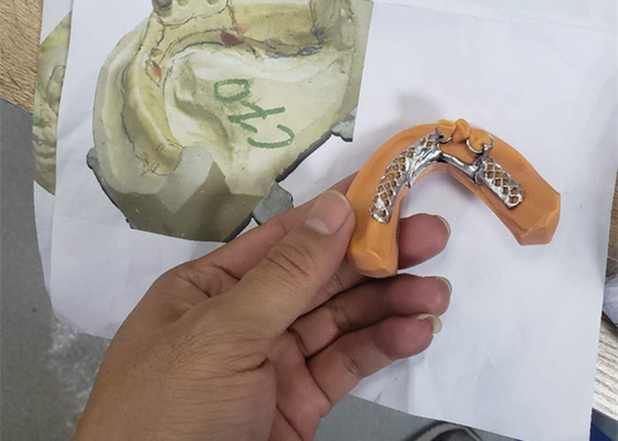 치과 의술의 3D 인쇄하는 제거할 수 있는 치아관 구조 모델들
