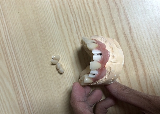 정확한 생물학적 적합성 치과용 임플란트 부착 치아 임플랜트 크라운