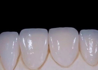 EMAX 내구성 CAD/CAM 치아 복합판 매우 상세한 정확