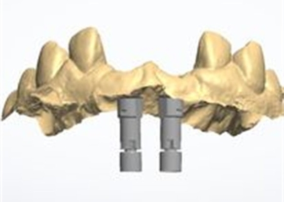 3D 모델 지르코니아 왕관