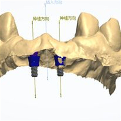 정밀 CAD/CAM 디자인