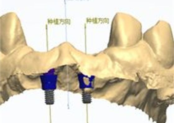 3D 모델 지르코니아 왕관
