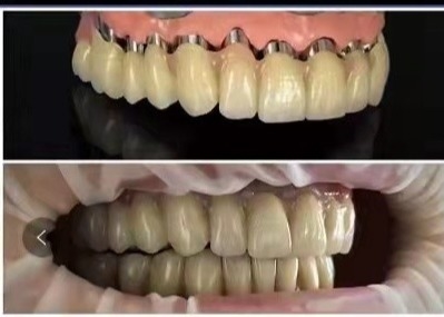 CAD 캠 PFM 임플란트 치관 다리 육안으로 보이지 않는 크라운 치아 인쇄된 모델들 3D명